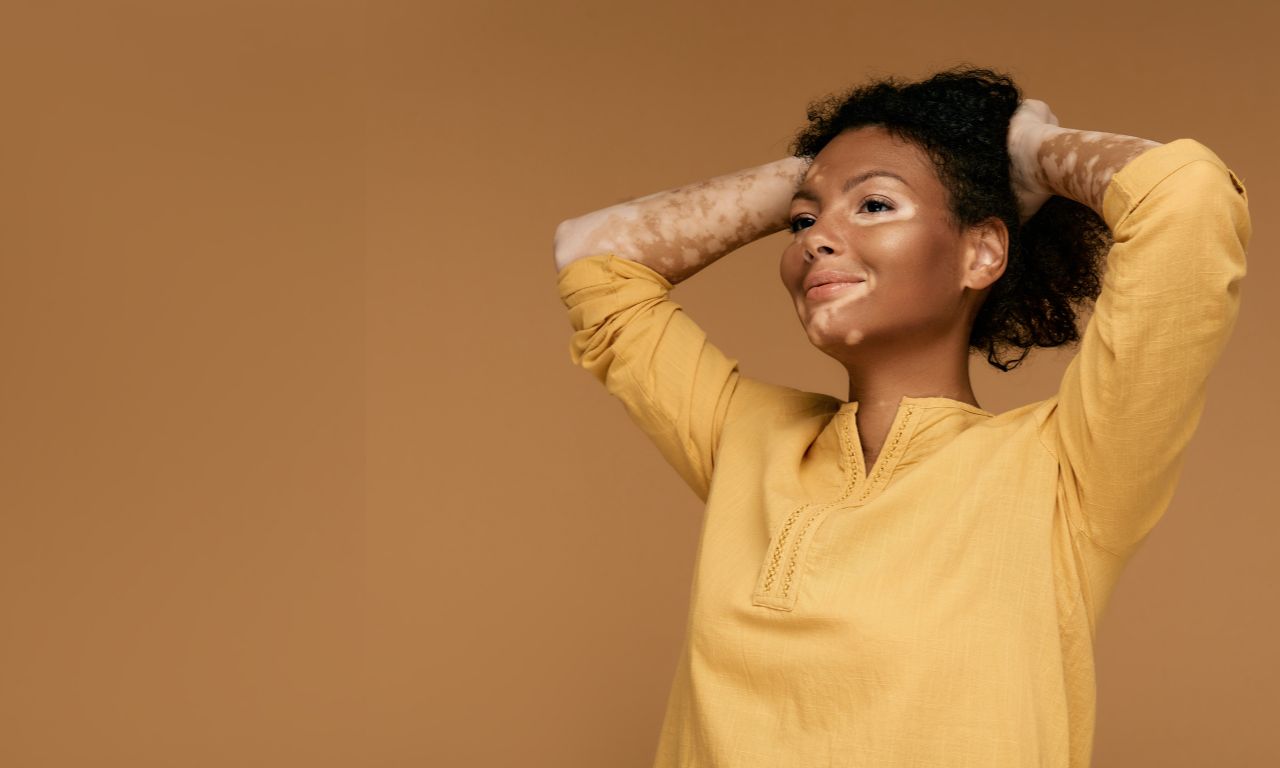 Portadores de Vitiligo